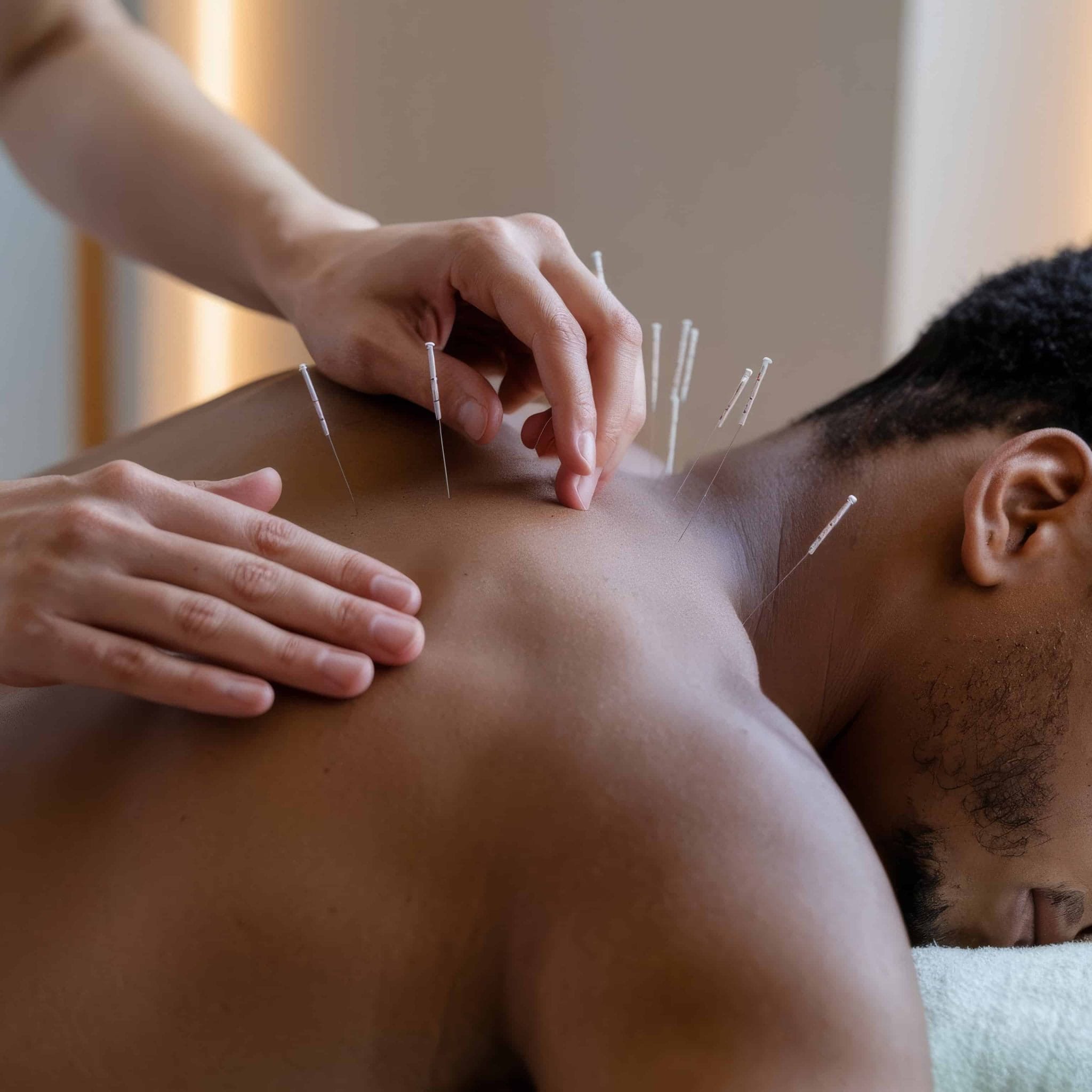 afroamericano recibiendo tratamiento de acupuntura