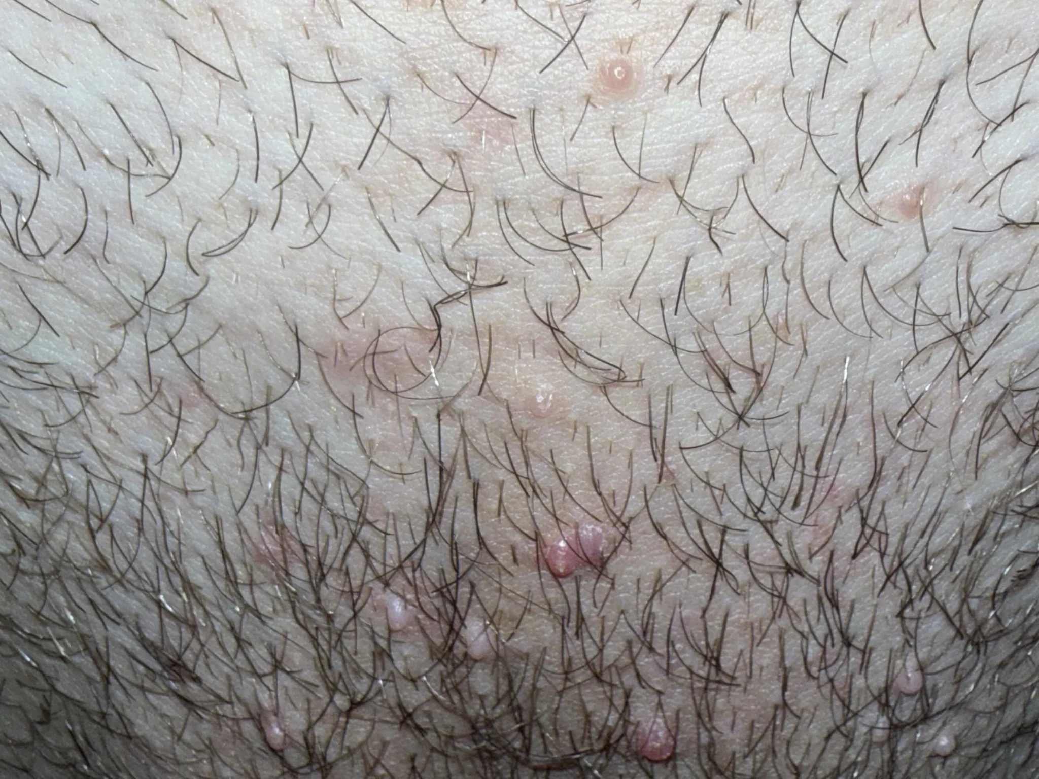 foliculitis genital