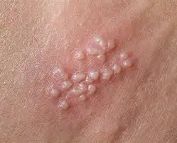 herpes genital