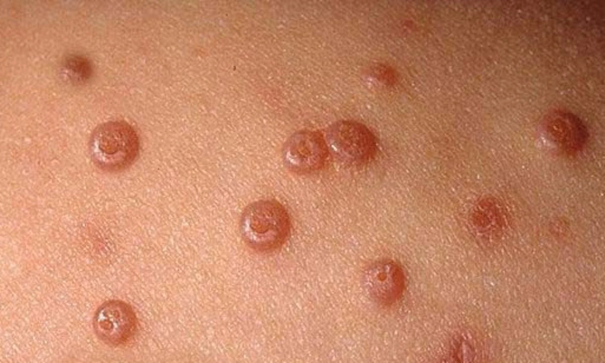 molusco contagioso