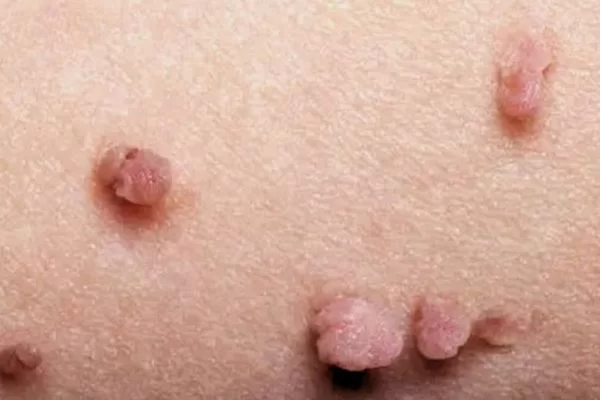 verrugas genitales vph